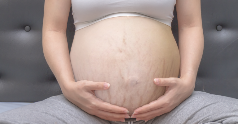 Changes in the Skin During Pregnancy