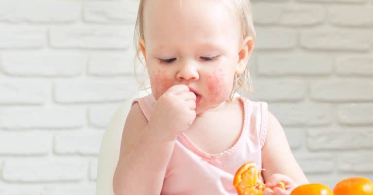 Bebeklerde Görülen Besin Alerjisi Hakkında Tüm Detaylar