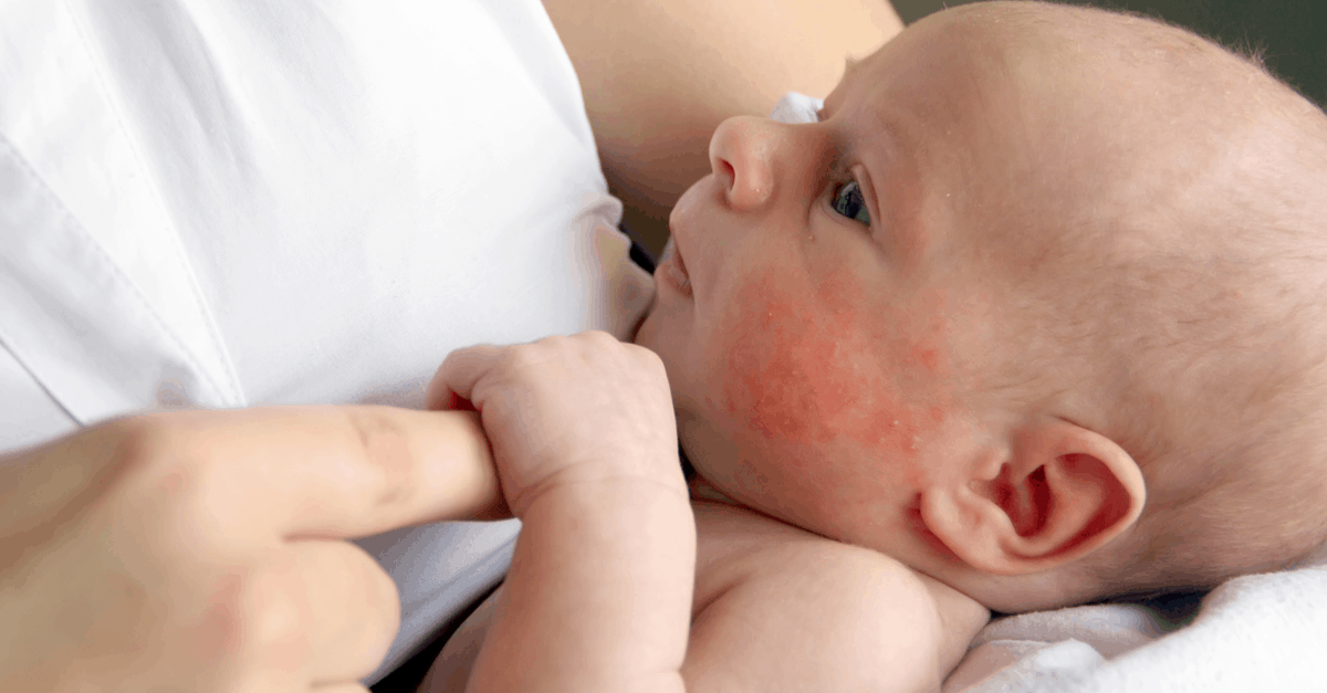 bebeklerde sut alerjisi