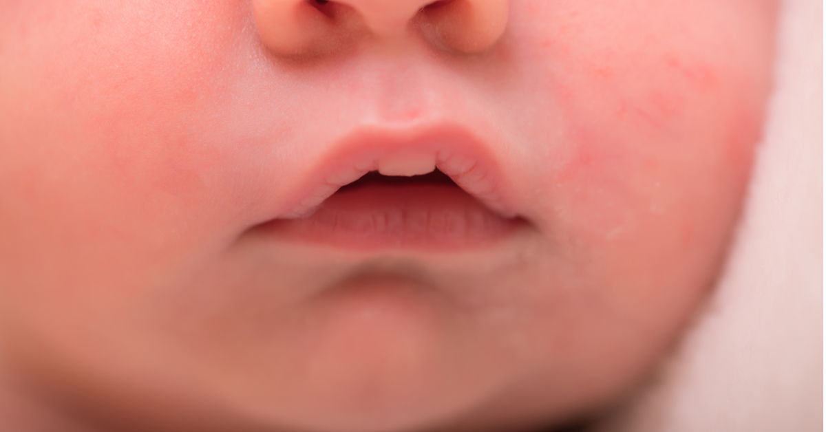 bebeklerde-dudak-kurulugu-dudak-catlamasi-neden-olur