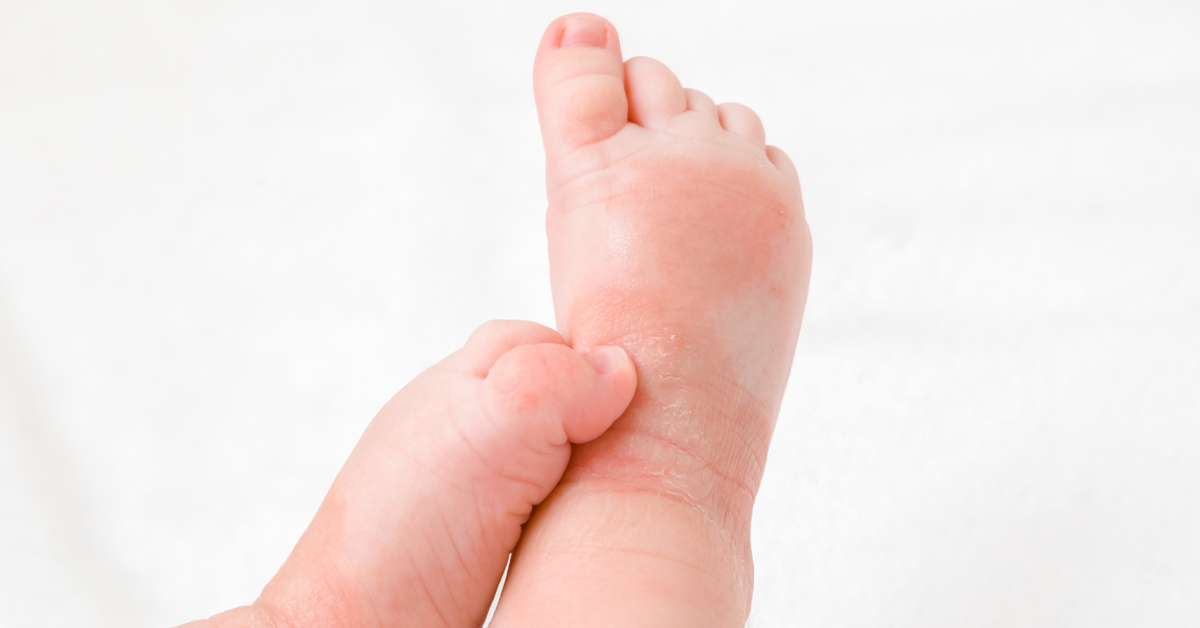 bebeklerde-alerji-belirtileri-nasil-anlasilir